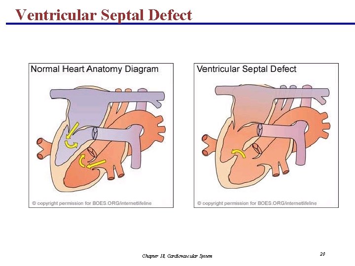 Ventricular Septal Defect Chapter 18, Cardiovascular System 20 