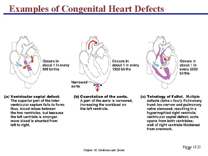 Examples of Congenital Heart Defects Chapter 18, Cardiovascular System Figure 18. 25 69 
