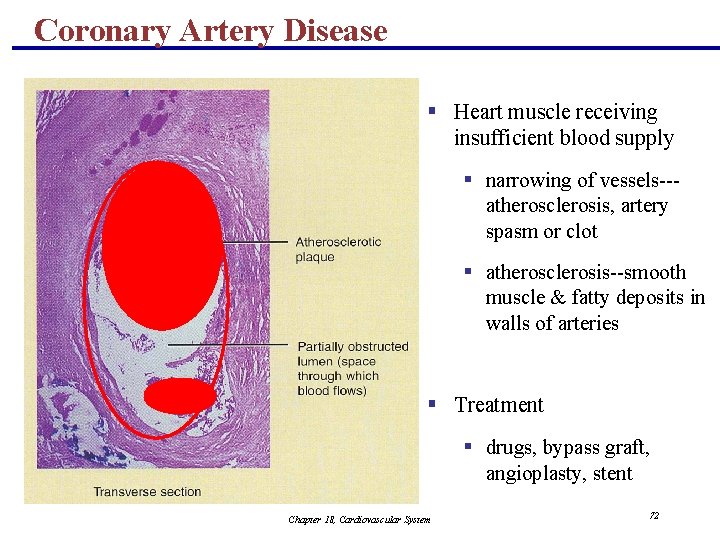 Coronary Artery Disease § Heart muscle receiving insufficient blood supply § narrowing of vessels--atherosclerosis,