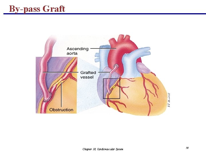 By-pass Graft Chapter 18, Cardiovascular System 74 