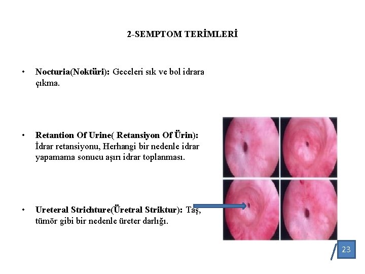 2 -SEMPTOM TERİMLERİ • Nocturia(Noktüri): Geceleri sık ve bol idrara çıkma. • Retantion Of