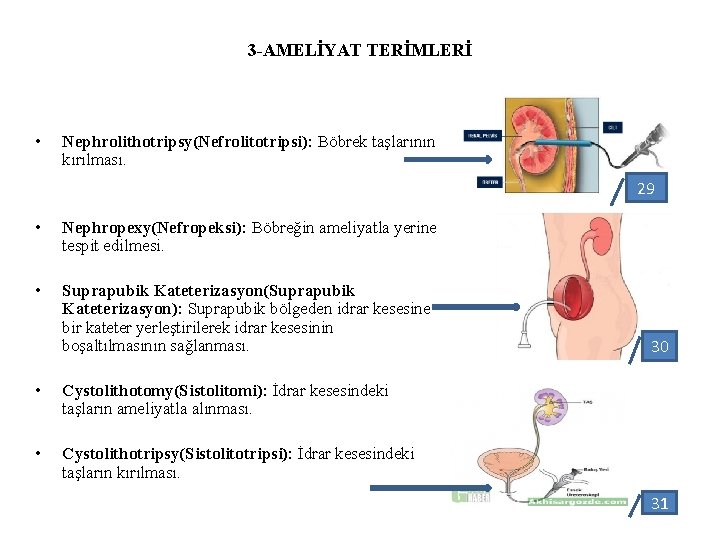 3 -AMELİYAT TERİMLERİ • Nephrolithotripsy(Nefrolitotripsi): Böbrek taşlarının kırılması. 29 • Nephropexy(Nefropeksi): Böbreğin ameliyatla yerine