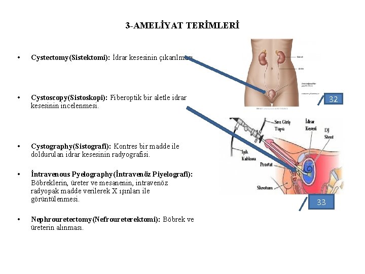 3 -AMELİYAT TERİMLERİ • Cystectomy(Sistektomi): İdrar kesesinin çıkarılması. • Cystoscopy(Sistoskopi): Fiberoptik bir aletle idrar