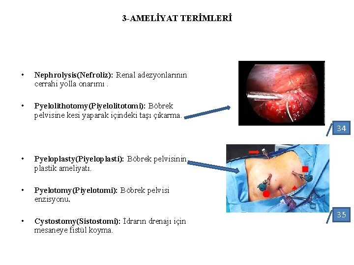3 -AMELİYAT TERİMLERİ • Nephrolysis(Nefroliz): Renal adezyonlarının cerrahi yolla onarımı. • Pyelolithotomy(Piyelolitotomi): Böbrek pelvisine