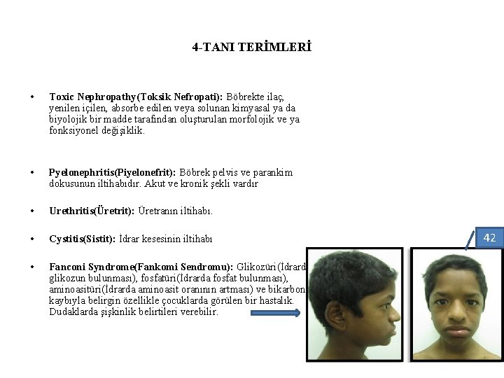 4 -TANI TERİMLERİ • Toxic Nephropathy(Toksik Nefropati): Böbrekte ilaç, yenilen içilen, absorbe edilen veya