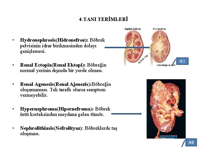 4 -TANI TERİMLERİ • Hydronephrosis(Hidronefroz): Böbrek pelvisinin idrar birikmesinden dolayı genişlemesi. • Renal Ectopia(Renal