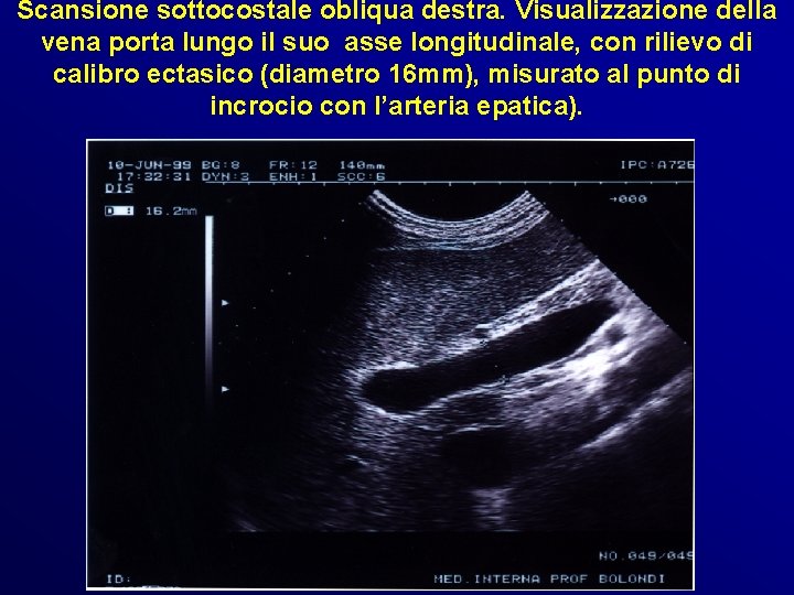 Scansione sottocostale obliqua destra. Visualizzazione della vena porta lungo il suo asse longitudinale, con Scansione sottocostale obliqua destra. Visualizzazione della vena porta lungo il suo asse longitudinale, con
