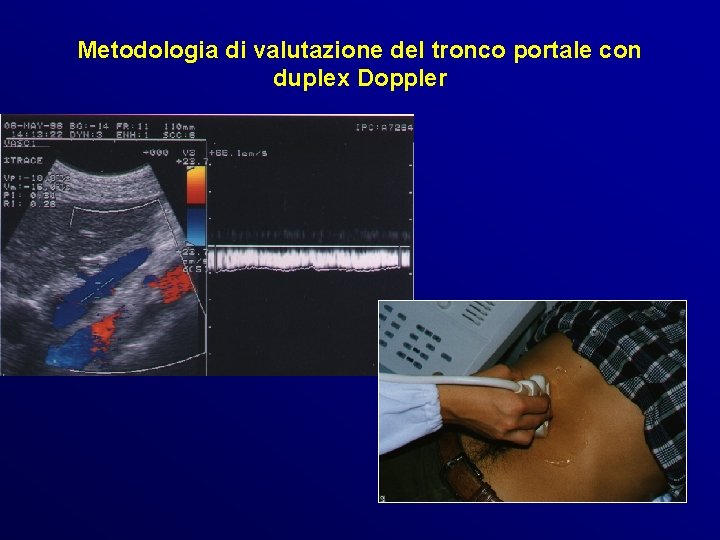 Metodologia di valutazione del tronco portale con duplex Doppler Metodologia di valutazione del tronco portale con duplex Doppler