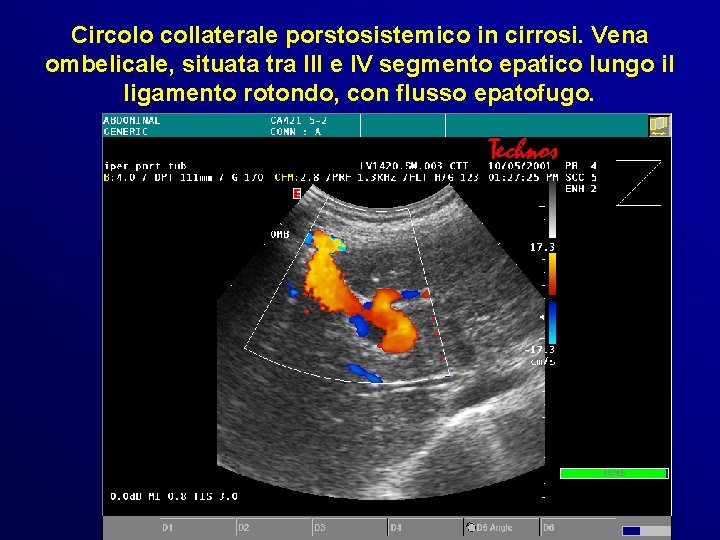 Circolo collaterale porstosistemico in cirrosi. Vena ombelicale, situata tra III e IV segmento epatico Circolo collaterale porstosistemico in cirrosi. Vena ombelicale, situata tra III e IV segmento epatico
