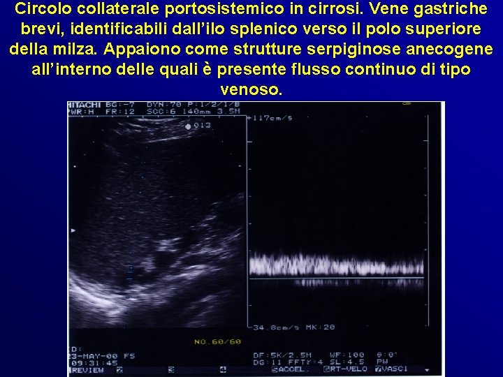 Circolo collaterale portosistemico in cirrosi. Vene gastriche brevi, identificabili dall’ilo splenico verso il polo Circolo collaterale portosistemico in cirrosi. Vene gastriche brevi, identificabili dall’ilo splenico verso il polo