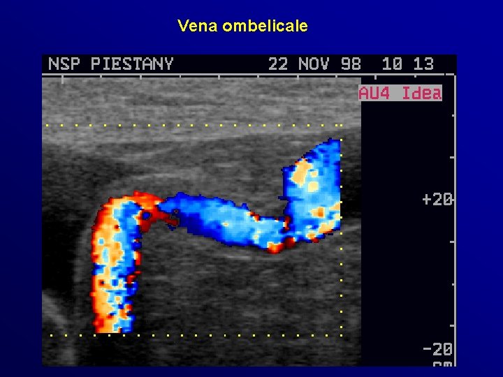 Vena ombelicale Vena ombelicale