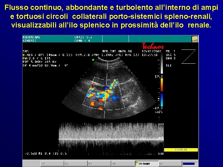 Flusso continuo, abbondante e turbolento all’interno di ampi e tortuosi circoli collaterali porto-sistemici spleno-renali, Flusso continuo, abbondante e turbolento all’interno di ampi e tortuosi circoli collaterali porto-sistemici spleno-renali,