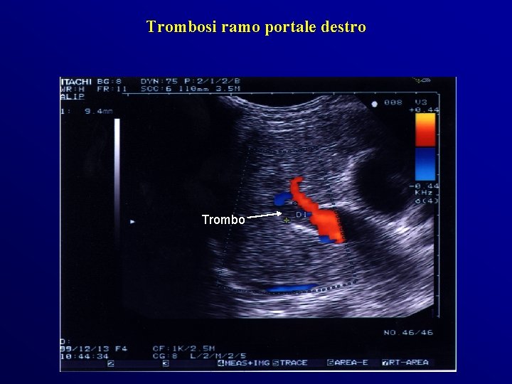 Trombosi ramo portale destro Trombo Trombosi ramo portale destro Trombo