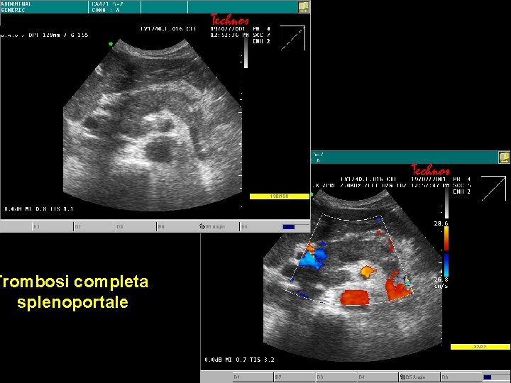 Trombosi completa splenoportale Trombosi completa splenoportale