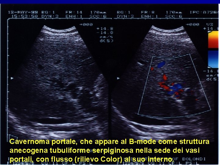 Cavernoma portale, che appare al B-mode come struttura anecogena tubuliforme serpiginosa nella sede dei Cavernoma portale, che appare al B-mode come struttura anecogena tubuliforme serpiginosa nella sede dei