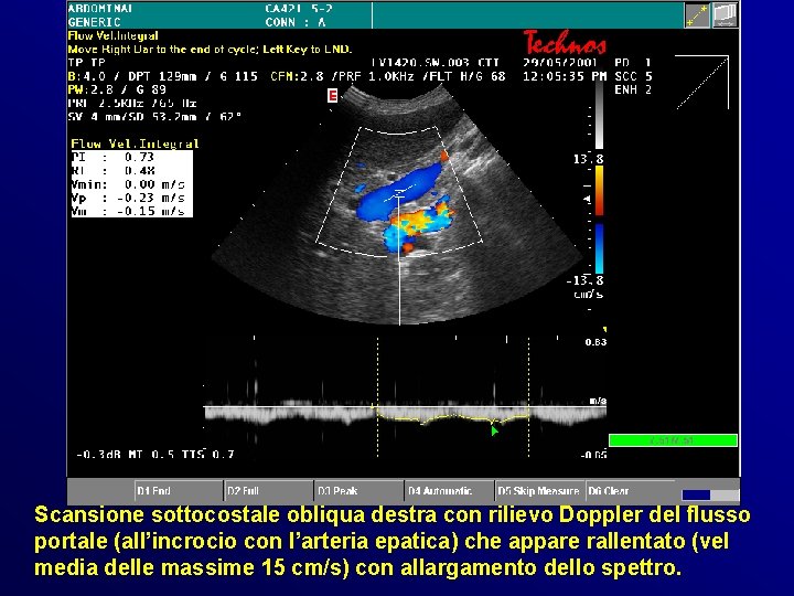 Scansione sottocostale obliqua destra con rilievo Doppler del flusso portale (all’incrocio con l’arteria epatica) Scansione sottocostale obliqua destra con rilievo Doppler del flusso portale (all’incrocio con l’arteria epatica)