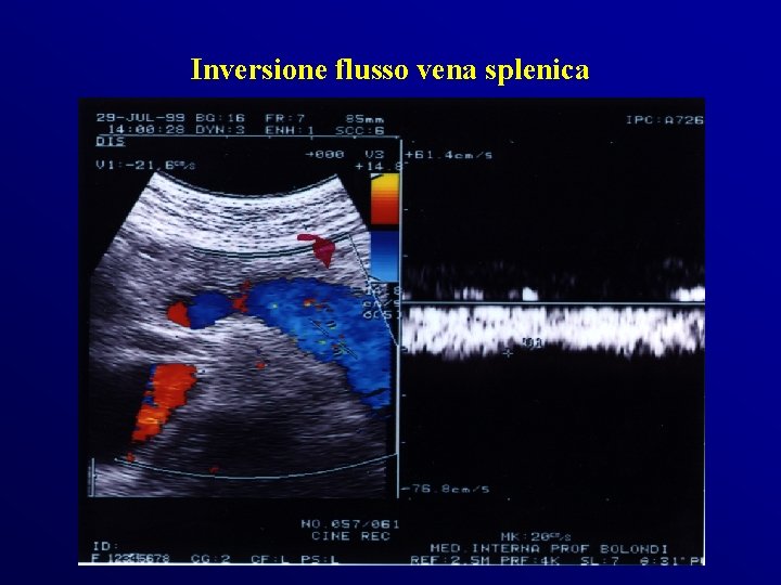 Inversione flusso vena splenica Inversione flusso vena splenica