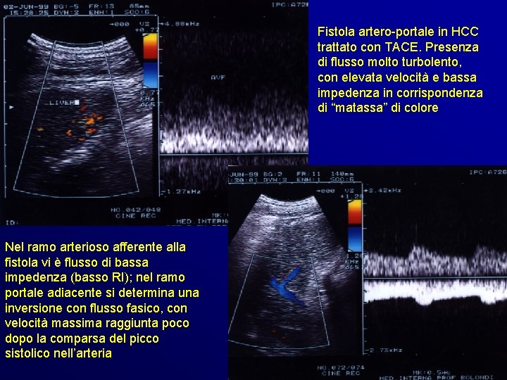 Fistola artero-portale in HCC trattato con TACE. Presenza di flusso molto turbolento, con elevata Fistola artero-portale in HCC trattato con TACE. Presenza di flusso molto turbolento, con elevata