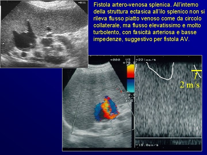 Fistola artero-venosa splenica. All’interno della struttura ectasica all’ilo splenico non si rileva flusso piatto Fistola artero-venosa splenica. All’interno della struttura ectasica all’ilo splenico non si rileva flusso piatto