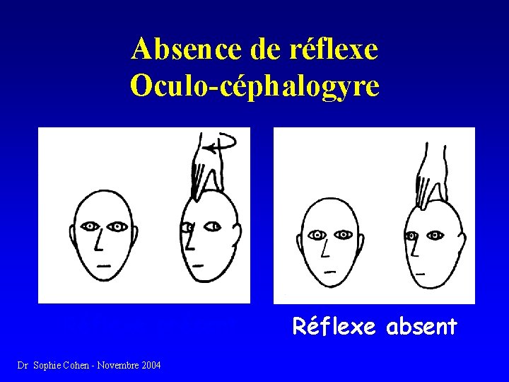 Absence de réflexe Oculo-céphalogyre Réflexe présent Dr Sophie Cohen - Novembre 2004 Réflexe absent