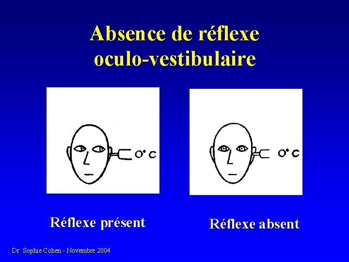 Absence de réflexe oculo-vestibulaire Réflexe présent Dr Sophie Cohen - Novembre 2004 Réflexe absent