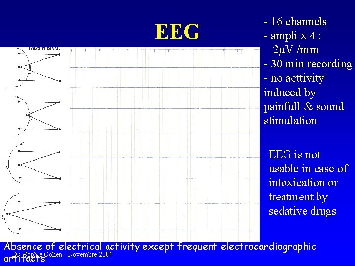 EEG - 16 channels - ampli x 4 : 2µV /mm - 30 min
