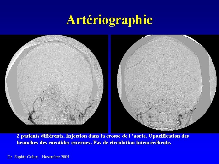 Artériographie 2 patients différents. Injection dans la crosse de l ’aorte. Opacification des branches