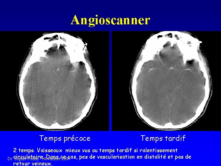 Angioscanner Temps précoce Temps tardif 2 temps. Vaisseaux mieux vus au temps tardif si