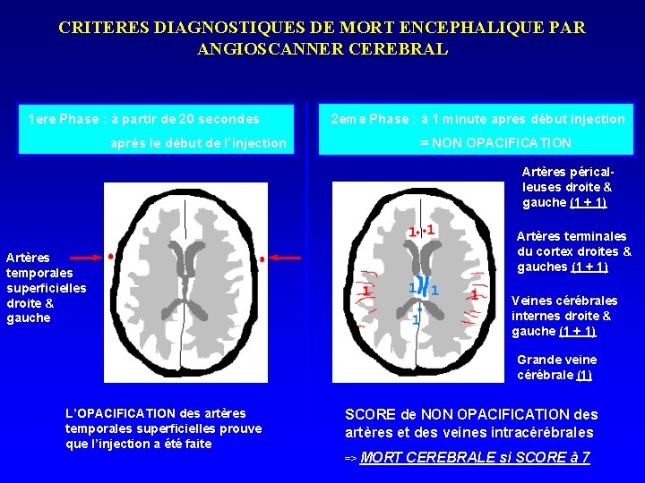 CRITERES DIAGNOSTIQUES DE MORT ENCEPHALIQUE PAR ANGIOSCANNER CEREBRAL 1 ere Phase : à partir