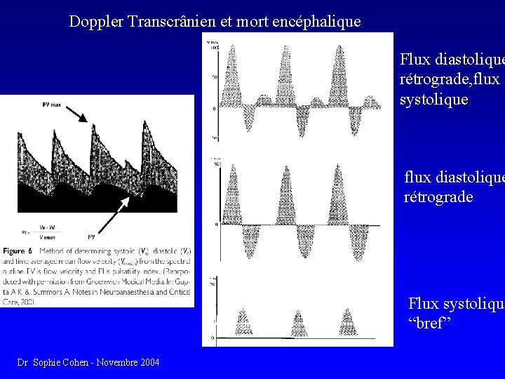 Doppler Transcrânien et mort encéphalique Flux diastolique rétrograde, flux systolique flux diastolique rétrograde Flux