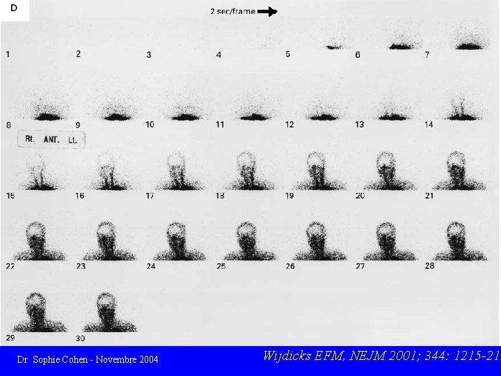 Dr Sophie Cohen - Novembre 2004 Wijdicks EFM, NEJM 2001; 344: 1215 -21 