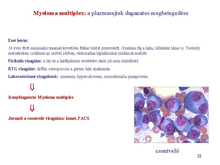 Myeloma multiplex: a plazmasejtek daganatos megbetegedése Eset leírás: 36 éves férfi minimális traumát követően Myeloma multiplex: a plazmasejtek daganatos megbetegedése Eset leírás: 36 éves férfi minimális traumát követően