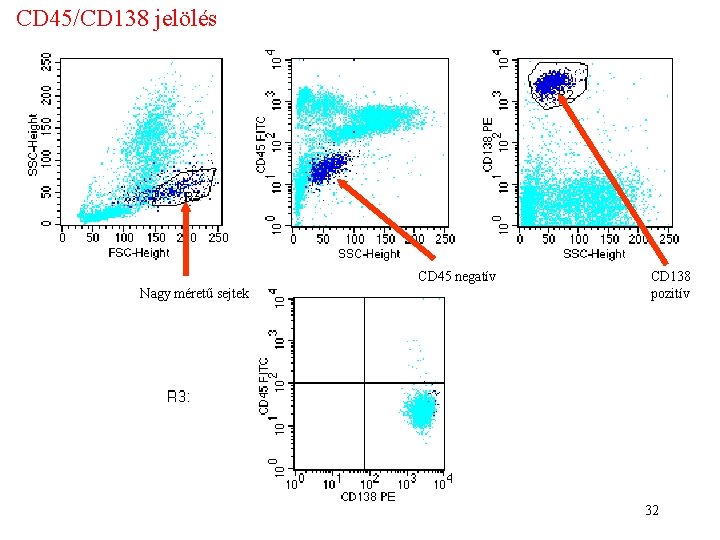 CD 45/CD 138 jelölés CD 45 negatív Nagy méretű sejtek CD 138 pozitív 32 CD 45/CD 138 jelölés CD 45 negatív Nagy méretű sejtek CD 138 pozitív 32