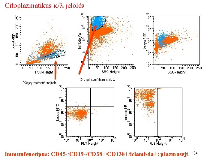 Citoplazmatikus k/l jelölés Nagy méretű sejtek Citoplazmában sok l Immunfenotípus: CD 45 -/CD 19 Citoplazmatikus k/l jelölés Nagy méretű sejtek Citoplazmában sok l Immunfenotípus: CD 45 -/CD 19