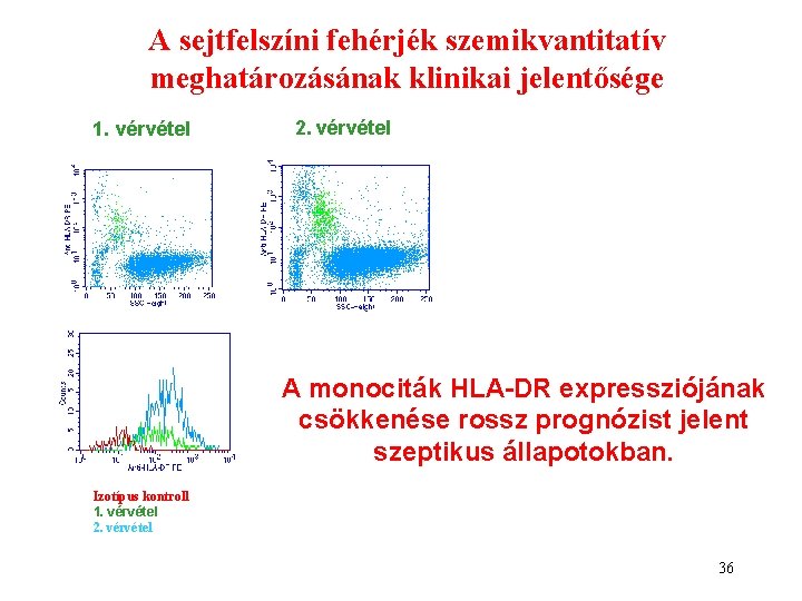 A sejtfelszíni fehérjék szemikvantitatív meghatározásának klinikai jelentősége 1. vérvétel 2. vérvétel A monociták HLA-DR A sejtfelszíni fehérjék szemikvantitatív meghatározásának klinikai jelentősége 1. vérvétel 2. vérvétel A monociták HLA-DR