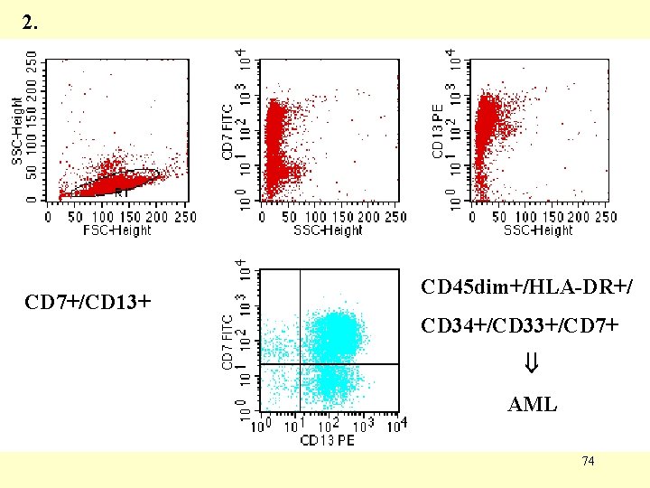 2. CD 7+/CD 13+ CD 45 dim+/HLA-DR+/ CD 34+/CD 33+/CD 7+ AML 74 2. CD 7+/CD 13+ CD 45 dim+/HLA-DR+/ CD 34+/CD 33+/CD 7+ AML 74