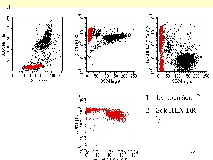 3. 1. Ly populáció 2. Sok HLA-DR+ ly 75 3. 1. Ly populáció 2. Sok HLA-DR+ ly 75