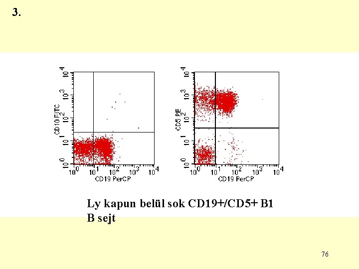 3. Ly kapun belül sok CD 19+/CD 5+ B 1 B sejt 76 3. Ly kapun belül sok CD 19+/CD 5+ B 1 B sejt 76
