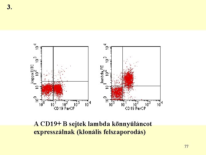 3. A CD 19+ B sejtek lambda könnyűláncot expresszálnak (klonális felszaporodás) 77 3. A CD 19+ B sejtek lambda könnyűláncot expresszálnak (klonális felszaporodás) 77