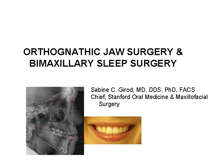 ORTHOGNATHIC JAW SURGERY & BIMAXILLARY SLEEP SURGERY Sabine C. Girod, MD, DDS, Ph. D,