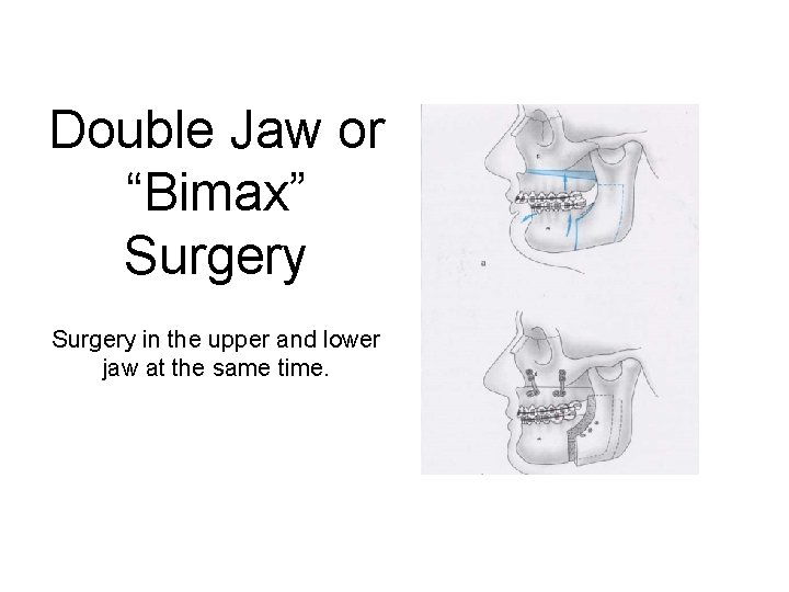 Operation bimax Surgical correction