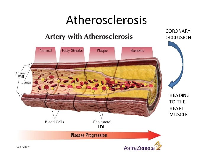 Atherosclerosis CORONARY OCCLUSION HEADING TO THE HEART MUSCLE LDL 