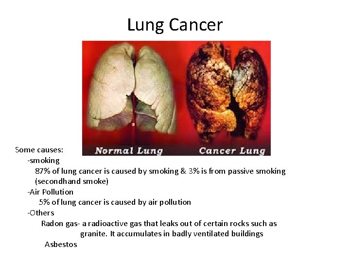Lung Cancer Some causes: -smoking 87% of lung cancer is caused by smoking &