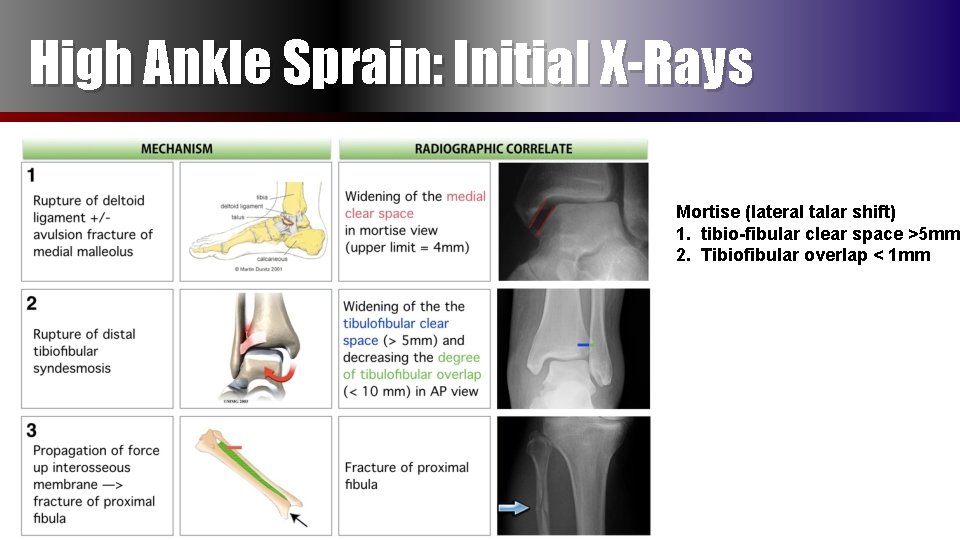 High Ankle Sprain Initial XRays Mortise Lateral Talar High Ankle Sprain Initial XRays Mortise Lateral Talar