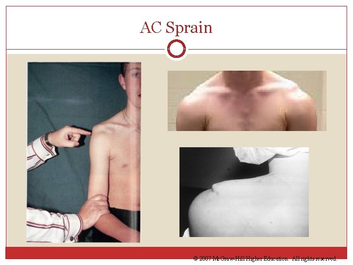 AC Sprain © 2007 Mc. Graw-Hill Higher Education. All rights reserved. 