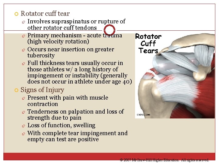  Rotator cuff tear Involves supraspinatus or rupture of other rotator cuff tendons Primary