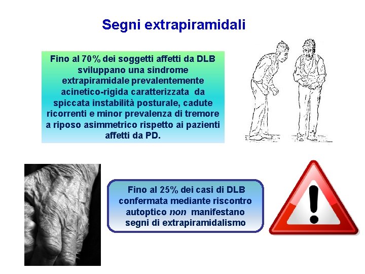 Segni extrapiramidali Fino al 70% dei soggetti affetti da DLB sviluppano una sindrome extrapiramidale Segni extrapiramidali Fino al 70% dei soggetti affetti da DLB sviluppano una sindrome extrapiramidale
