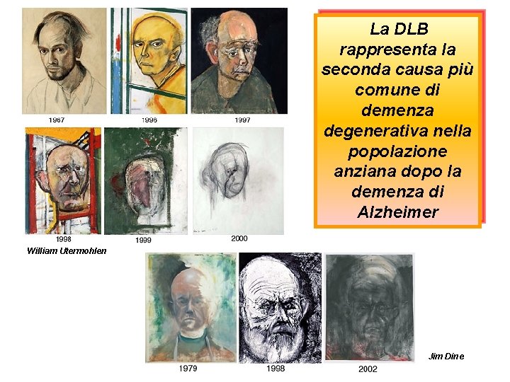 La DLB rappresenta la seconda causa più comune di demenza degenerativa nella popolazione anziana La DLB rappresenta la seconda causa più comune di demenza degenerativa nella popolazione anziana