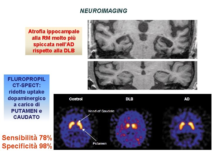 NEUROIMAGING Atrofia ippocampale alla RM molto più spiccata nell’AD rispetto alla DLB FLUROPROPIL CT-SPECT: NEUROIMAGING Atrofia ippocampale alla RM molto più spiccata nell’AD rispetto alla DLB FLUROPROPIL CT-SPECT:
