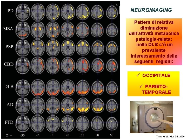 NEUROIMAGING Pattern di relativa diminuzione dell’attività metabolica patologia-relata: nella DLB c’è un prevalente interessamento NEUROIMAGING Pattern di relativa diminuzione dell’attività metabolica patologia-relata: nella DLB c’è un prevalente interessamento
